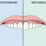 Bruxismo: entenda como a pandemia pode afetar nossos dentes